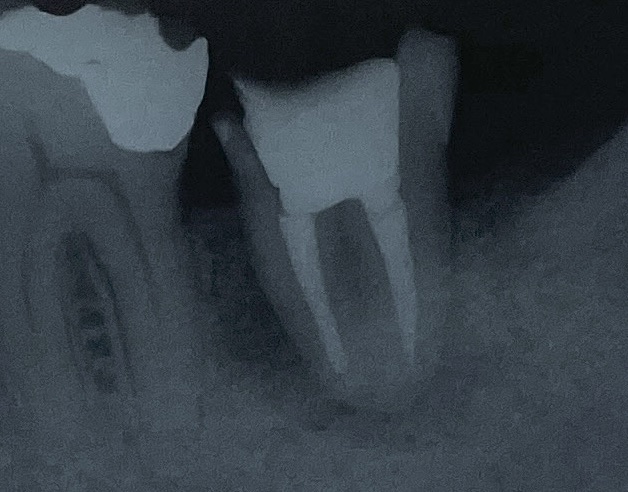 【下顎第二大臼歯】根管治療2年経過