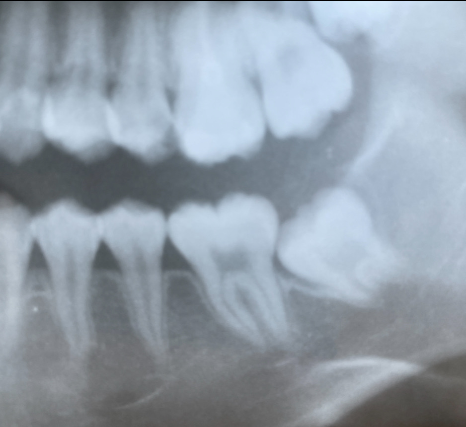 10才で永久歯(6才臼歯)を抜歯した症例の5年経過